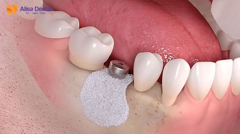 Ghép xương trong trồng răng implant là gì