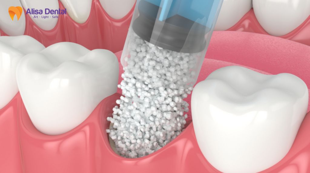 Ghép xương trong trồng răng implant là gì