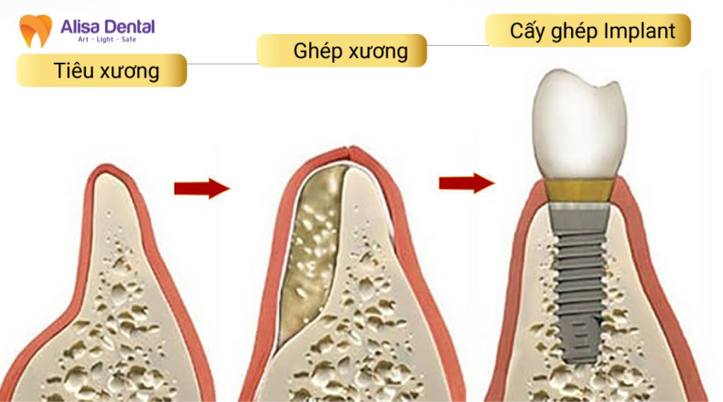 Ghép xương trong trồng răng implant là gì