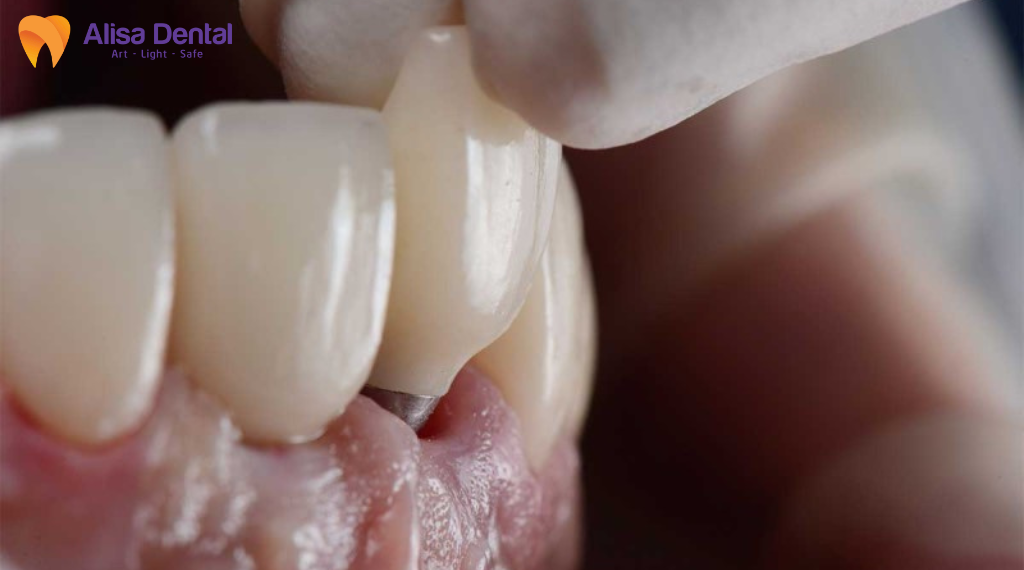 implant-bi-lung-lay-xu-ly-nhu-the-nao