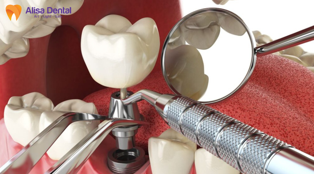 implant-bi-lung-lay-xu-ly-nhu-the-nao