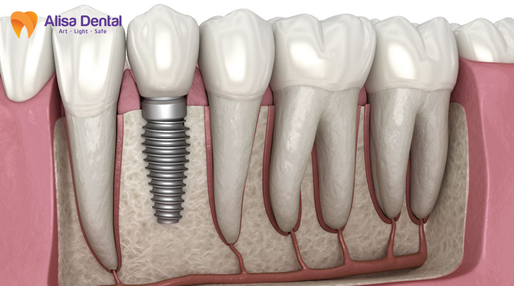 implant-co-gay-hoi-mieng-khong
