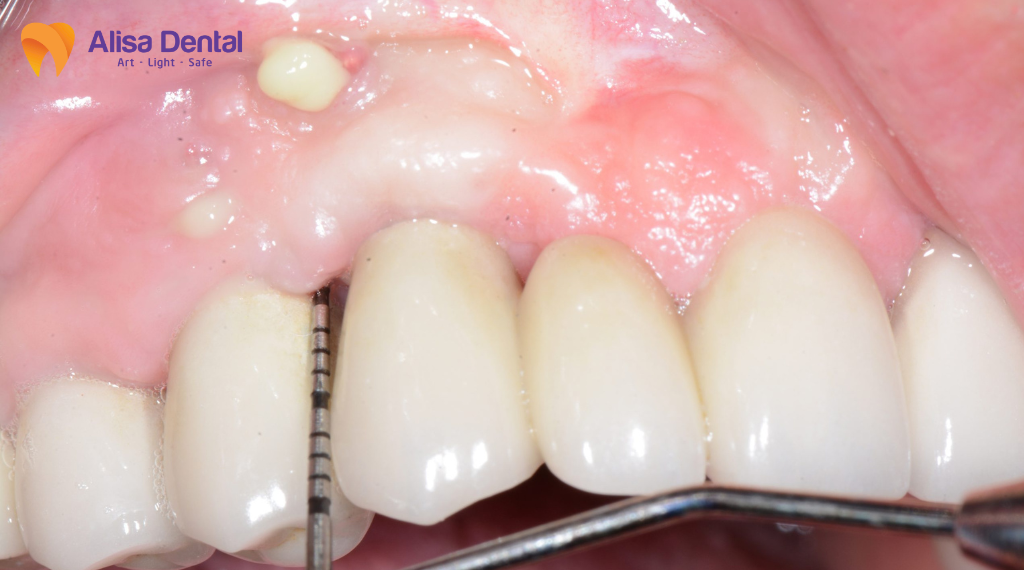 implant-co-gay-hoi-mieng-khong