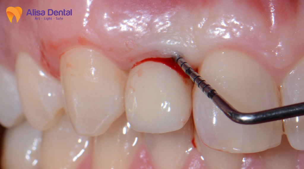 implant-co-gay-hoi-mieng-khong