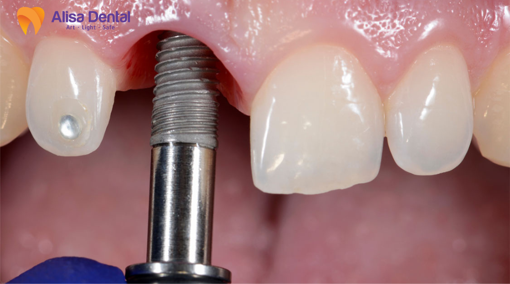 implant-tuc-thi-la-gi