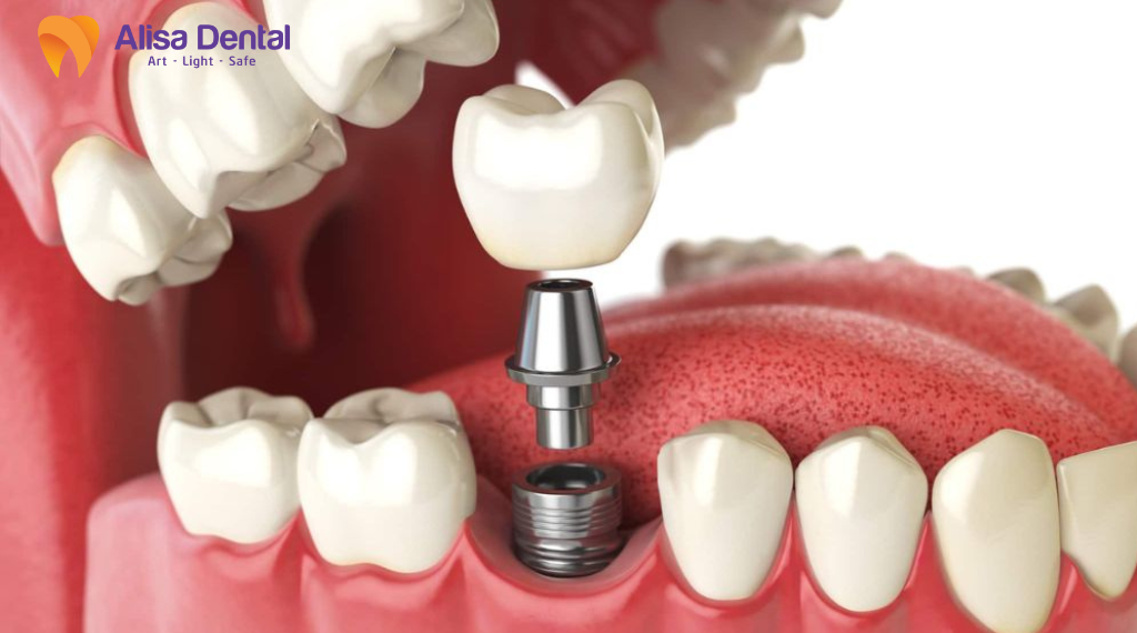 implant-tuc-thi-la-gi