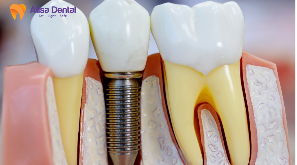 implant-tuc-thi-la-gi