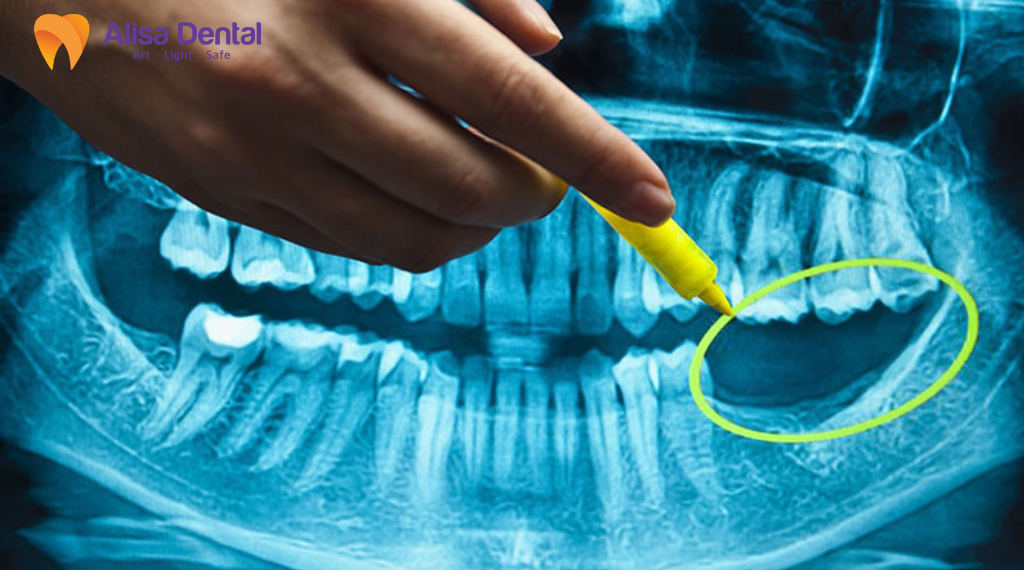 implant-tuc-thi-la-gi