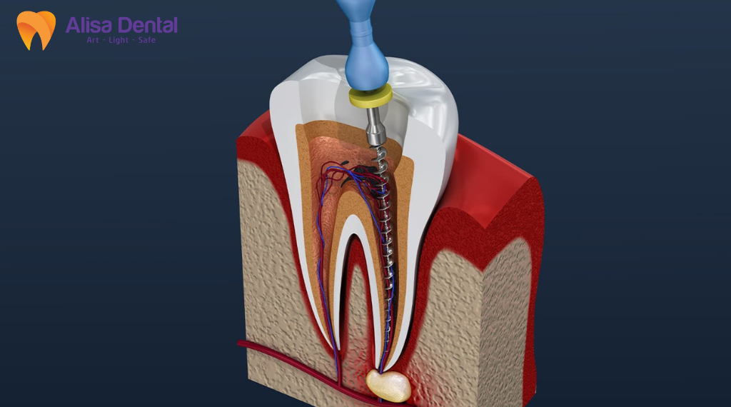 me-rang-do-can-vao-vat-cung