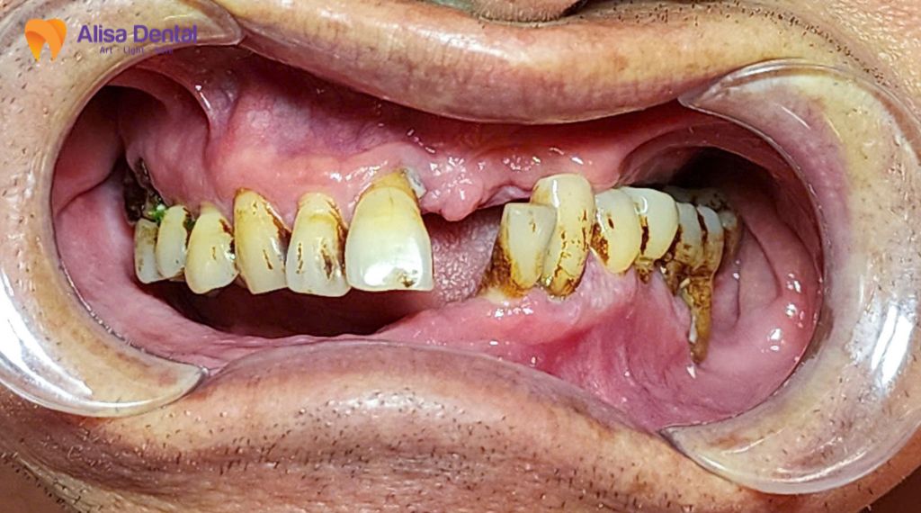 Nha chu và bệnh tim mạch liên quan thế nào