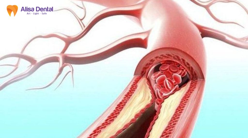 Nha chu và bệnh tim mạch liên quan thế nào