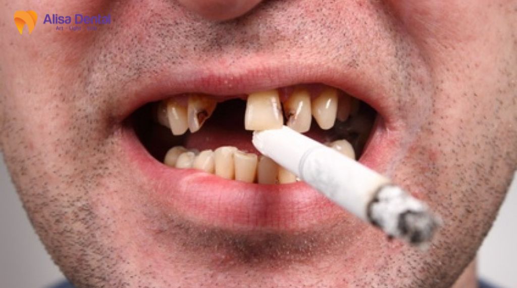 Nha chu và bệnh tim mạch liên quan thế nào