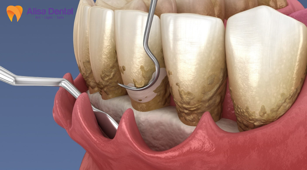 Phau-thuat-lat-vat-dieu-tri-nha-chu-la-gi
