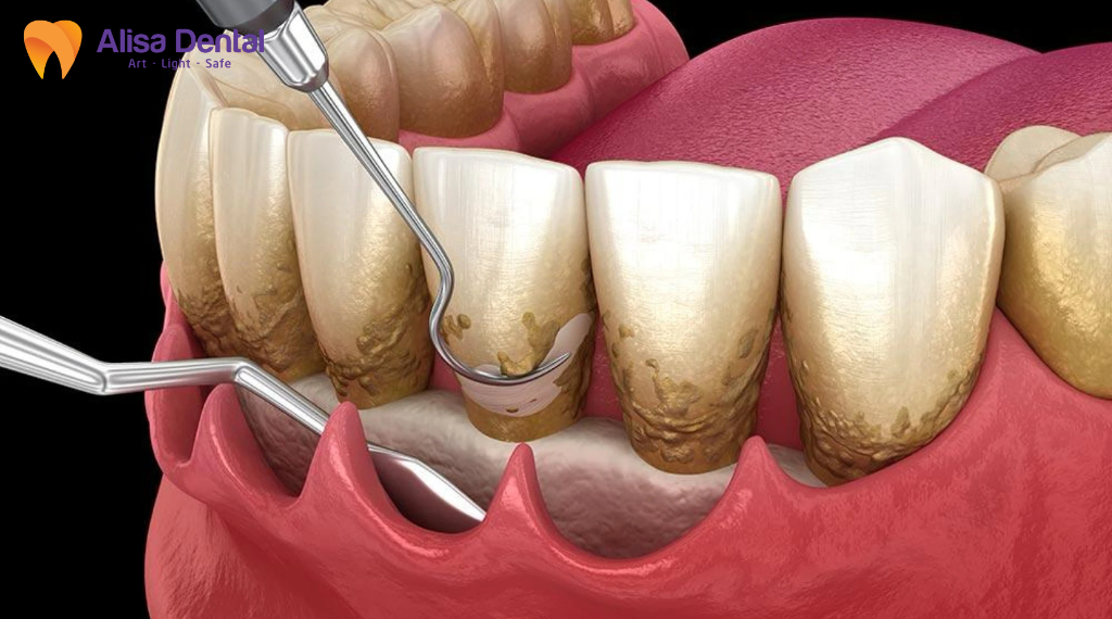Phau-thuat-lat-vat-dieu-tri-nha-chu-la-gi