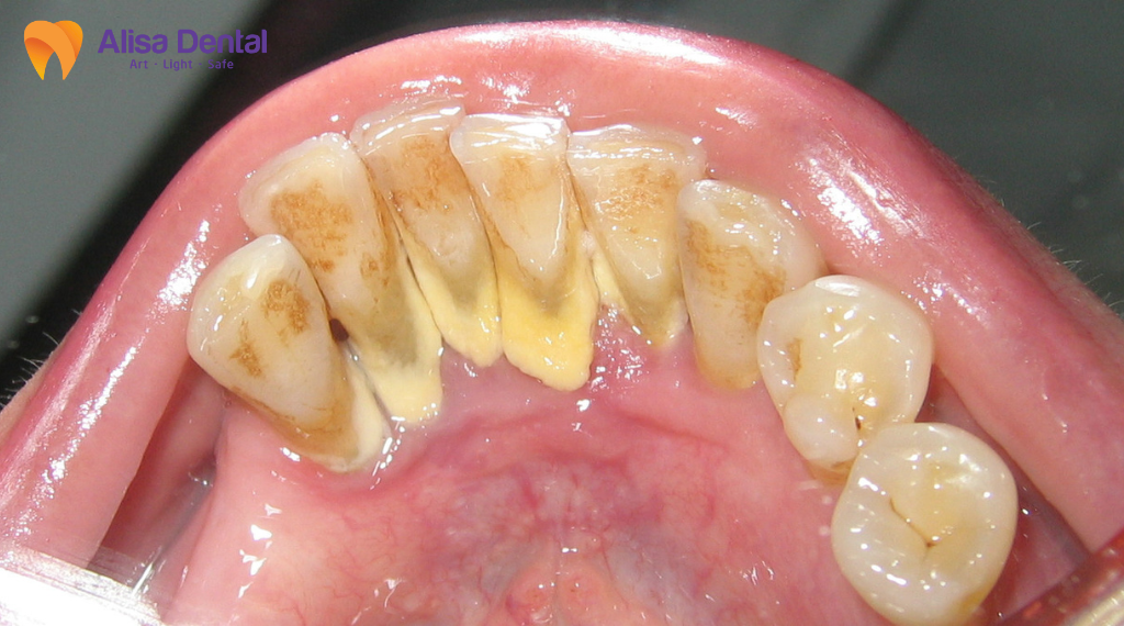 Phau-thuat-lat-vat-dieu-tri-nha-chu-la-gi