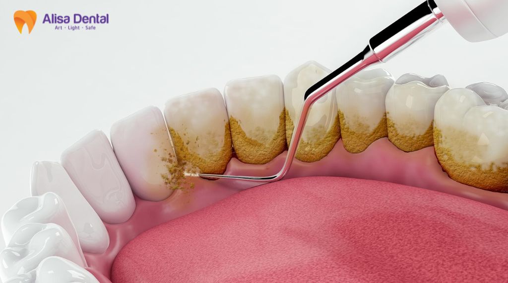 teeth whitening Hanoi