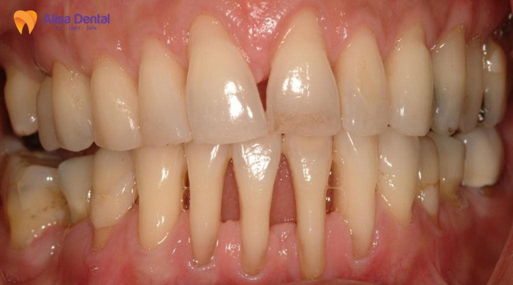 Tiêu xương hàm là gì