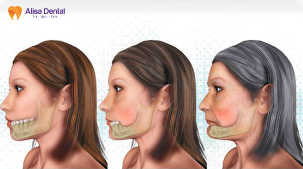 Tiêu xương hàm là gì