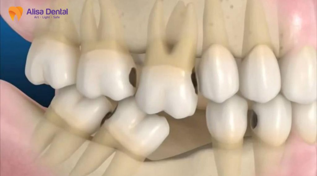 Tiêu xương hàm là gì