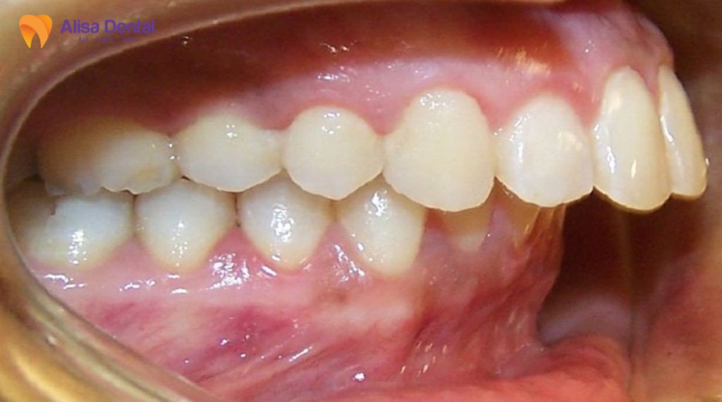 Tiêu xương hàm là gì