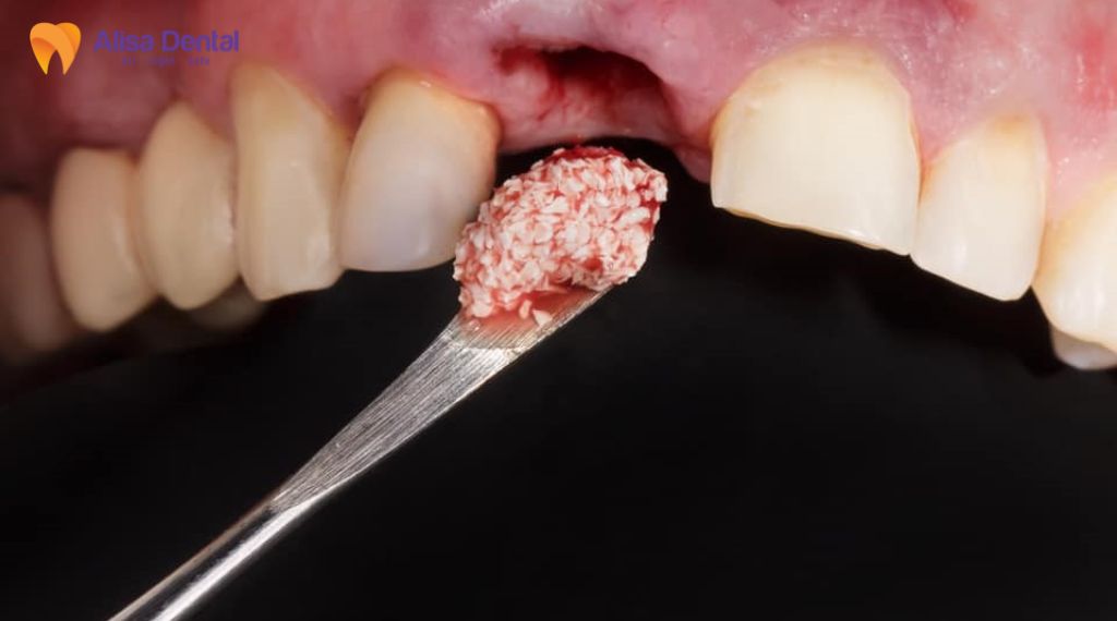 Tiêu xương hàm là gì