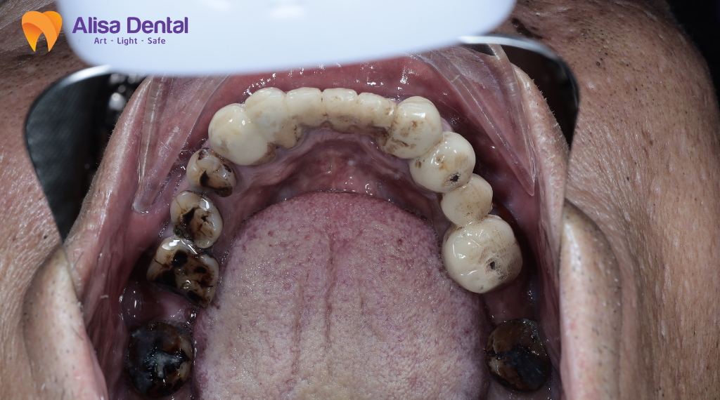 top-5-benh-ly-pho-bien-ve-rang