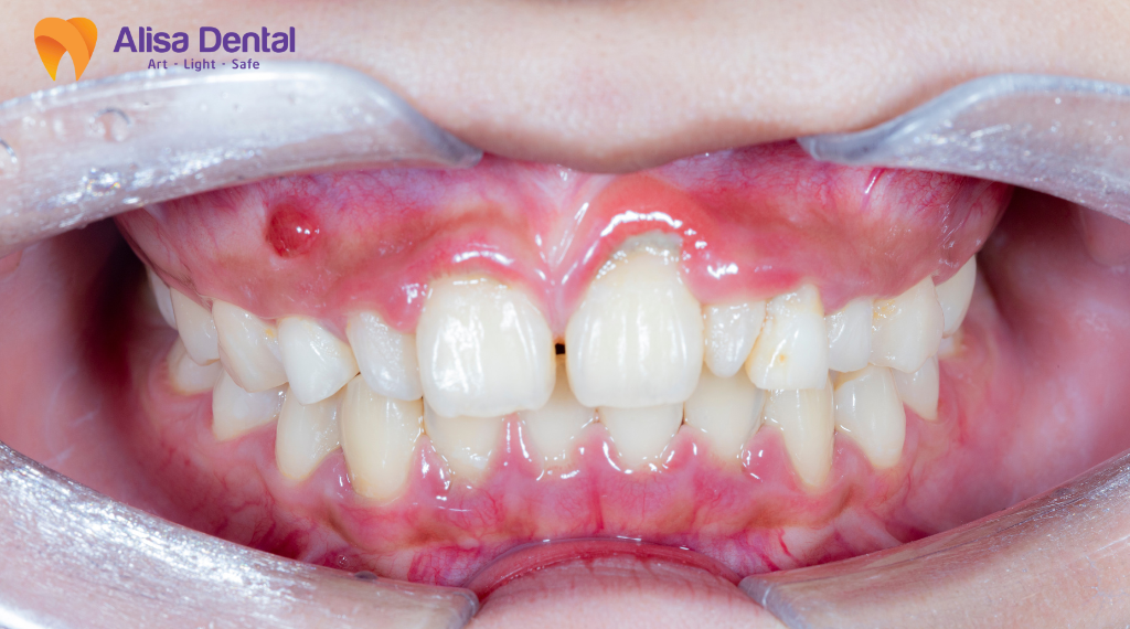 top-5-benh-ly-pho-bien-ve-rang