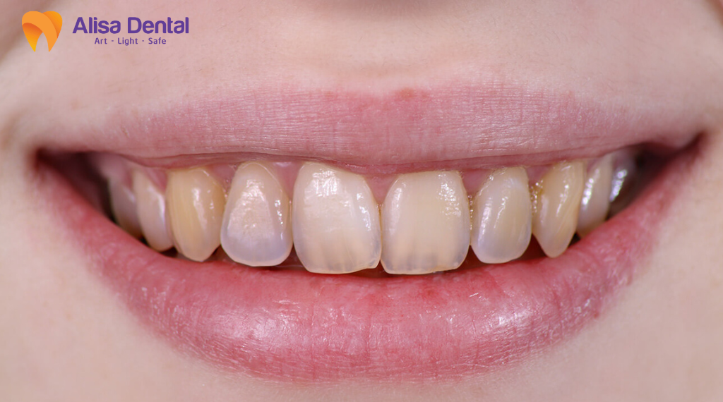 top-5-benh-ly-pho-bien-ve-rang