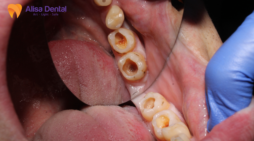 top-5-benh-ly-pho-bien-ve-rang