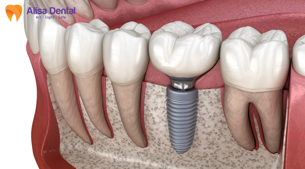 tuoi-tho-implant-bao-nhieu-nam