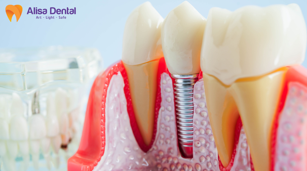 tuoi-tho-implant-bao-nhieu-nam