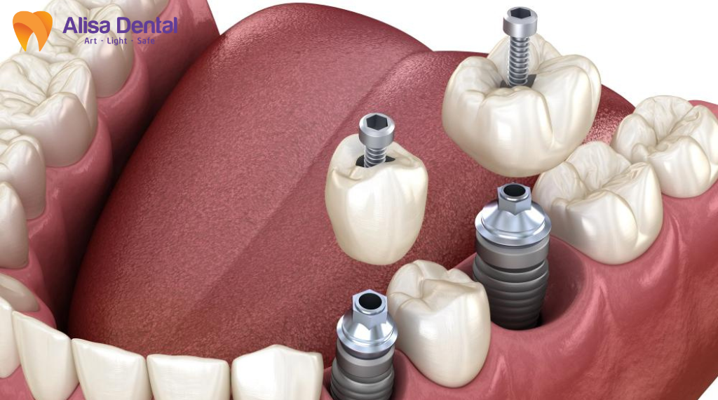 tuoi-tho-implant-bao-nhieu-nam