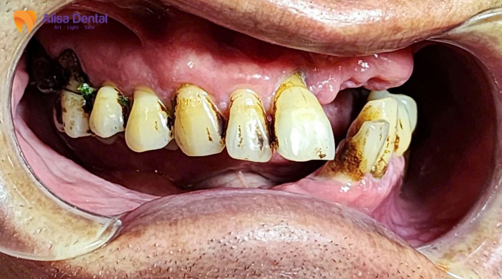 Các giai đoạn phát triển của bệnh nha chu