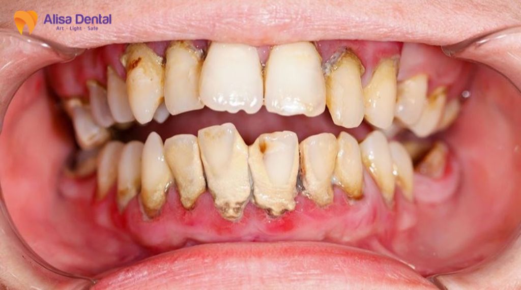 Các giai đoạn phát triển của bệnh nha chu