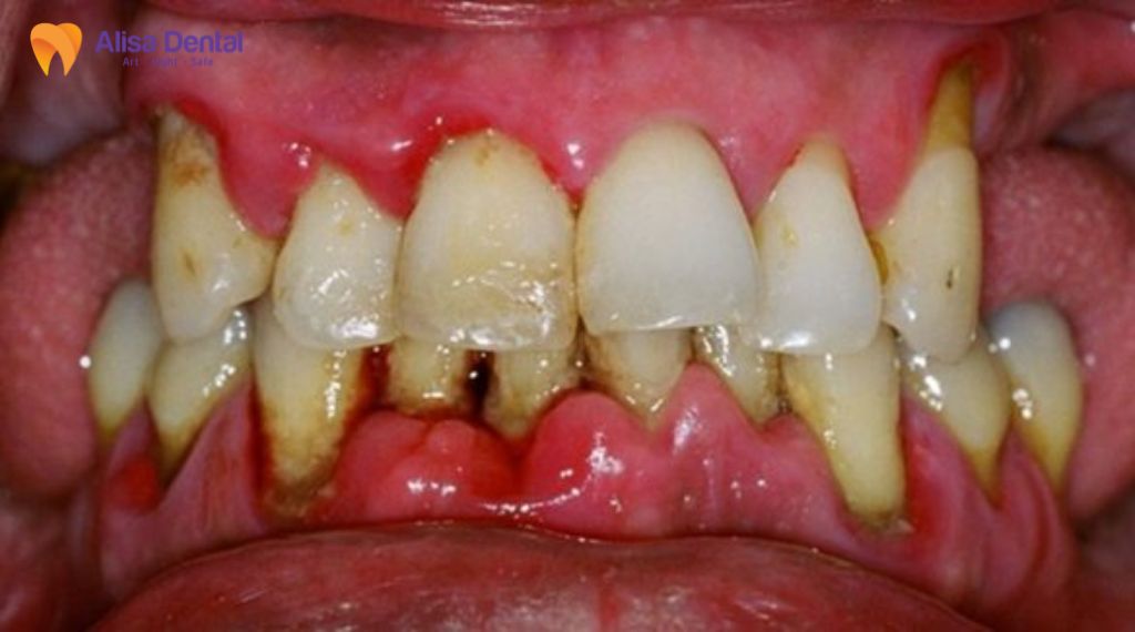 Các giai đoạn phát triển của bệnh nha chu