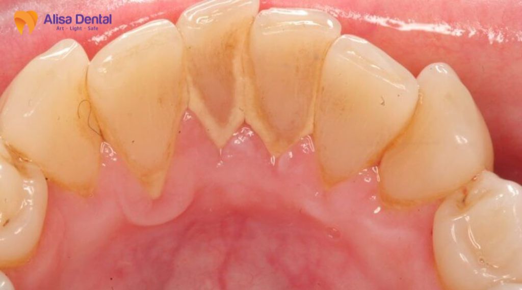 Các giai đoạn phát triển của bệnh nha chu