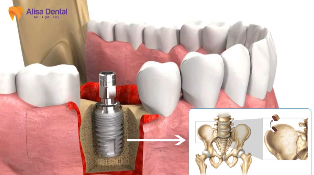 Các giai đoạn phát triển của bệnh nha chu
