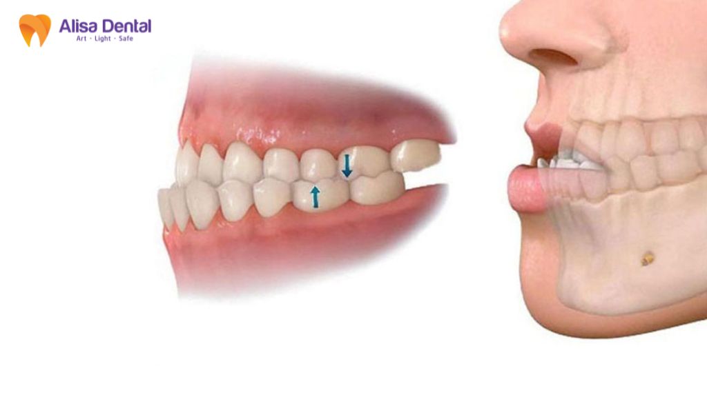 Khớp cắn ngược có nguy hiểm không