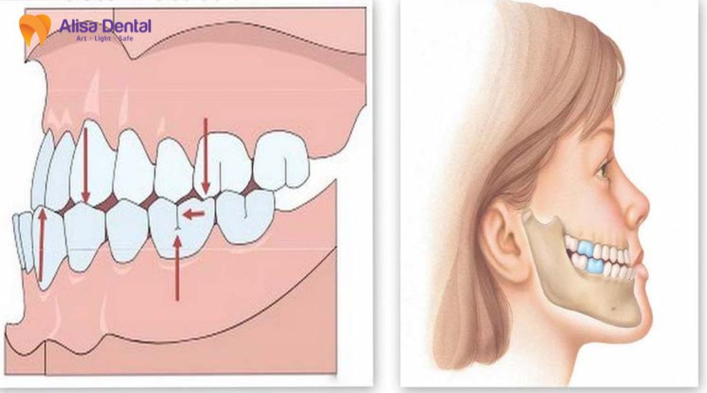 Khớp cắn ngược có nguy hiểm không