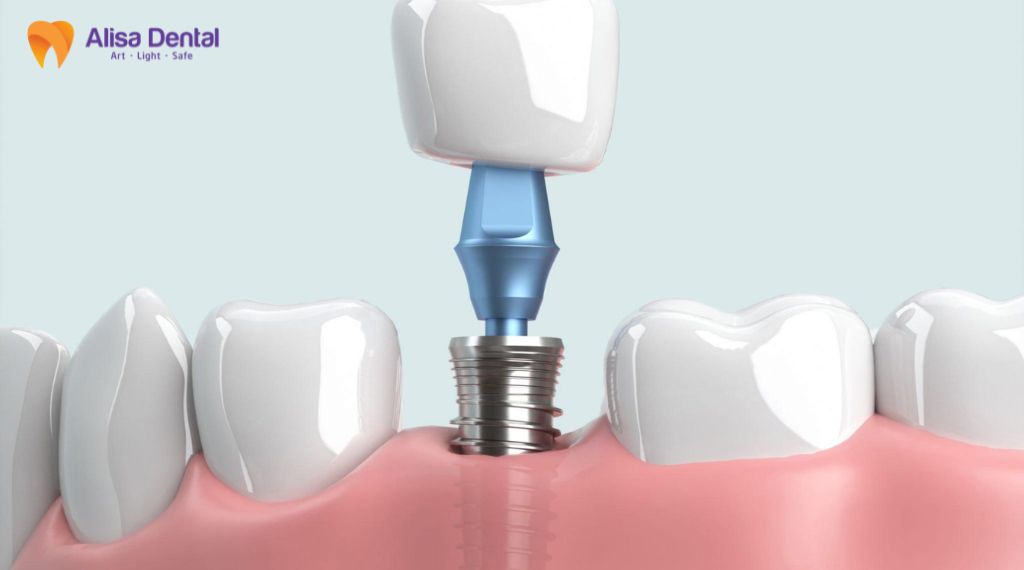 Niềng răng Implant Hà Nội