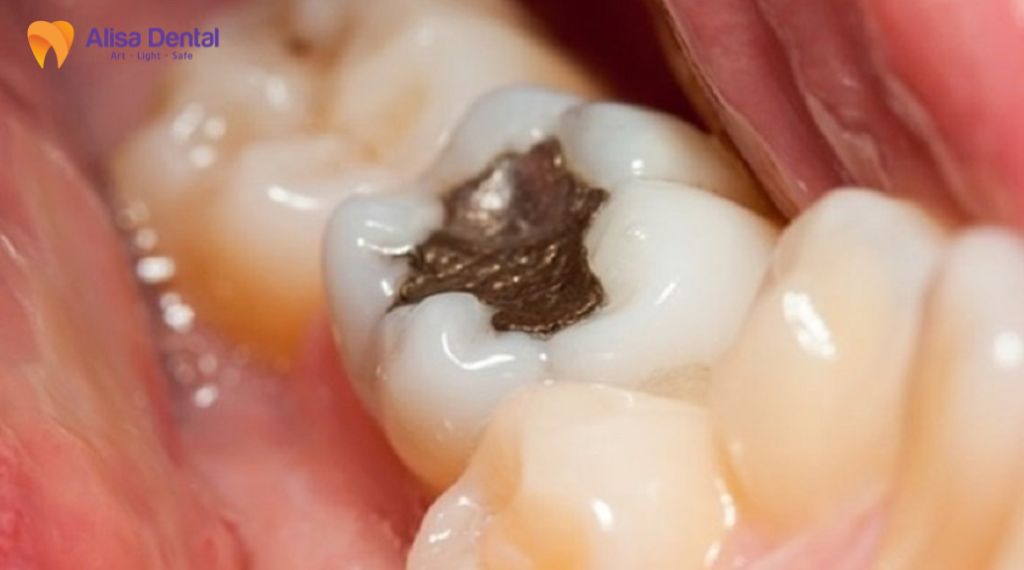 Trám răng bị rơi phải làm sao