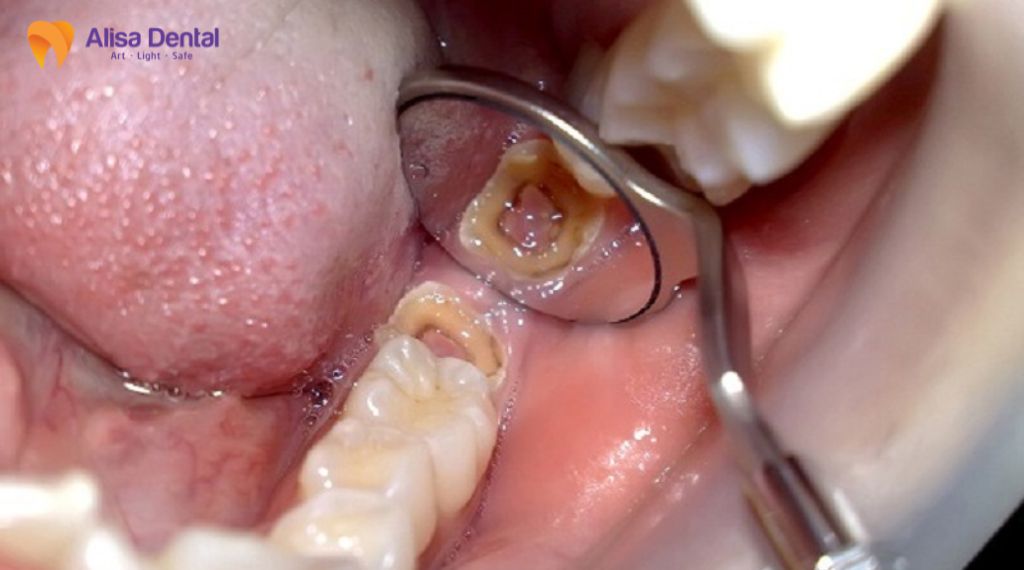 Trám răng bị rơi phải làm sao