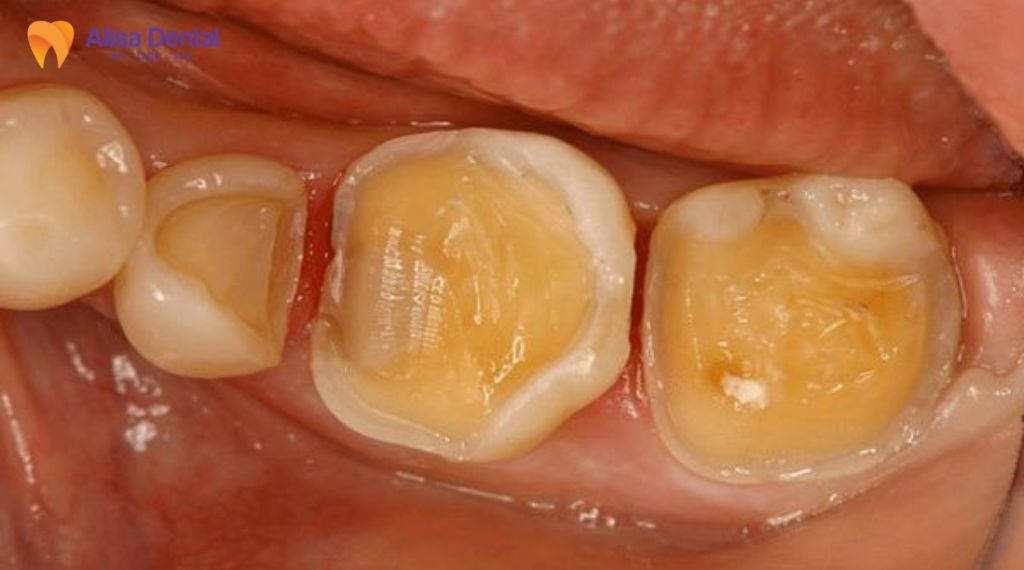 Trám răng bị rơi phải làm sao
