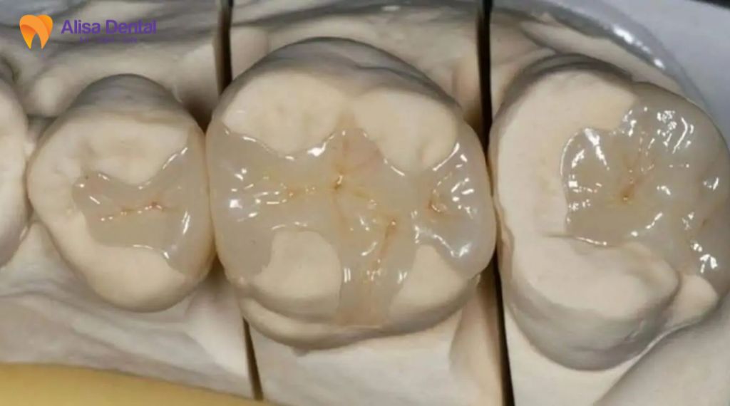 Trám răng bị rơi phải làm sao