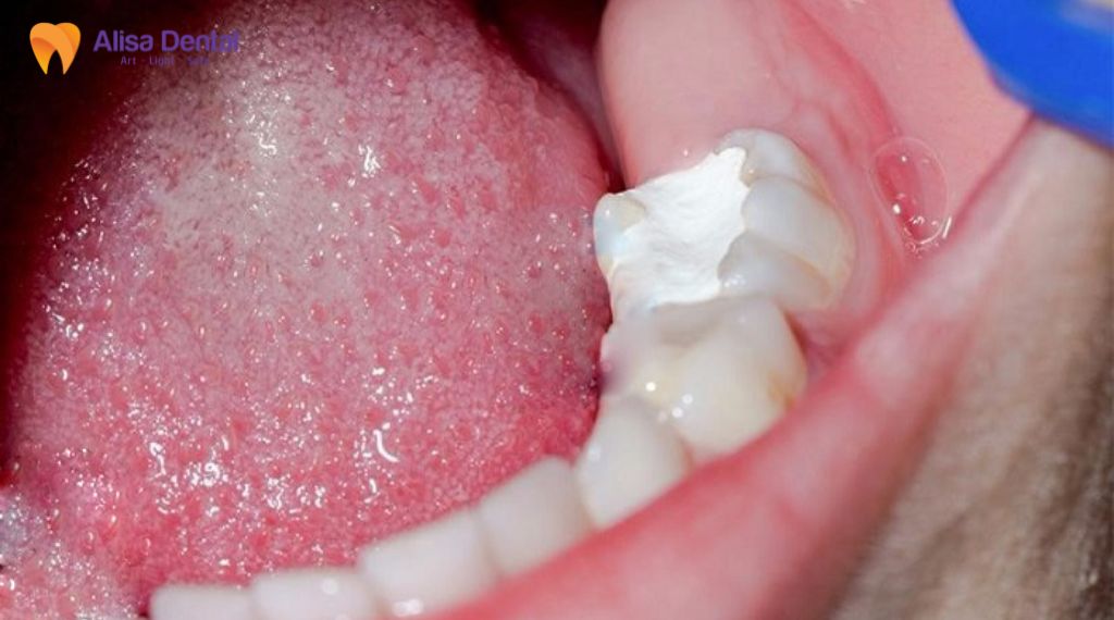 Trám răng bị rơi phải làm sao